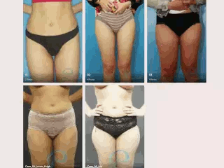 liposuction