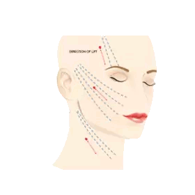 thread lift korea thread